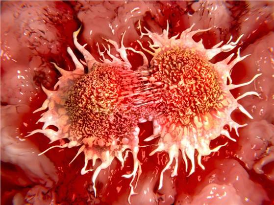 علاج جديد يقتل الخلايا السرطانية فى 60 ثانية فقط